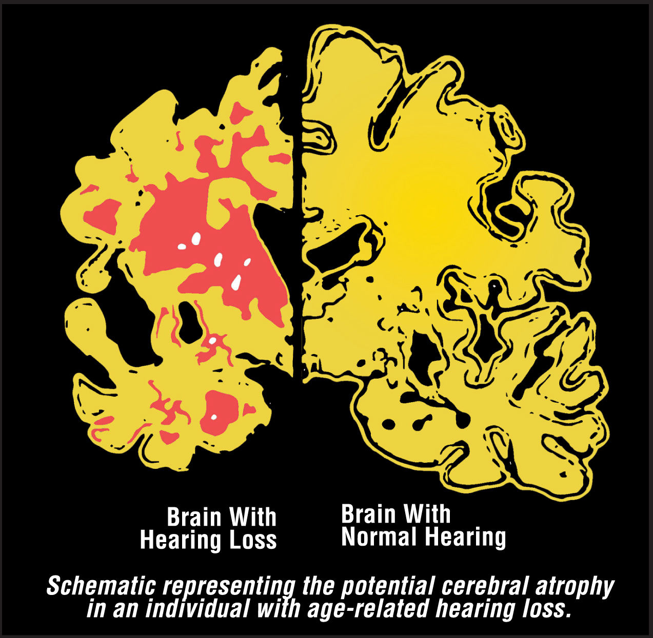 brain atrophy